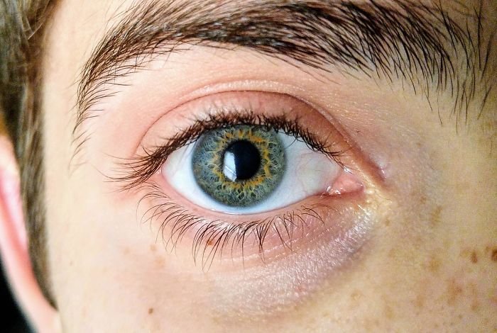 Amazing genetics golden ring in eye
